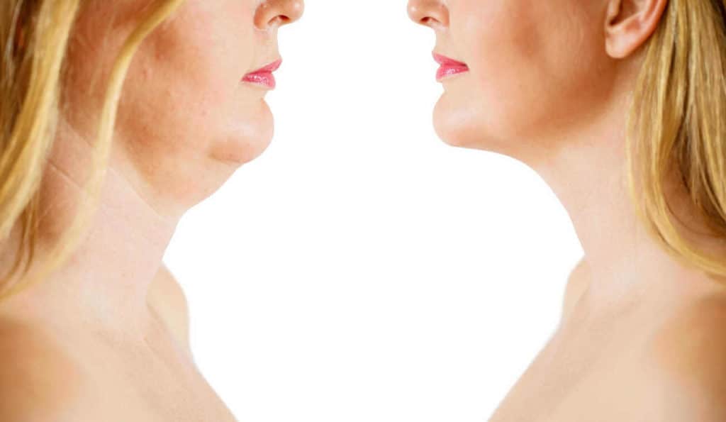 Double Chin treatment Bedford Park before and after results