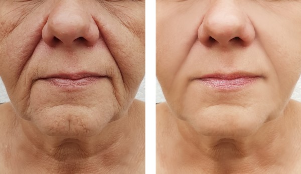 Learn more about Morpheus8 Treatment Bedford Park today!