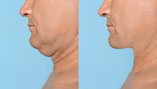Which Non-Surgical Treatments Work Best for Jowls and Loose Skin Bedford Park?