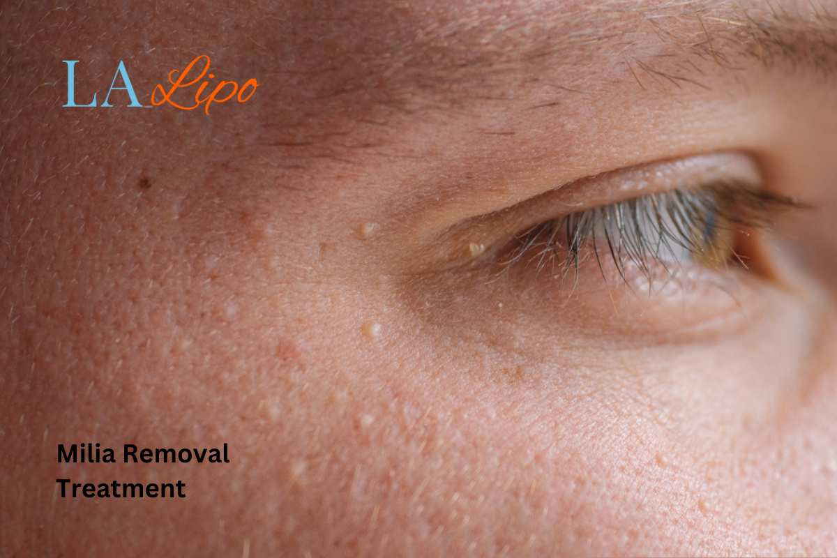 Cryopen Milia Removal: Is It the Easiest and Safest Option Bedford Park?