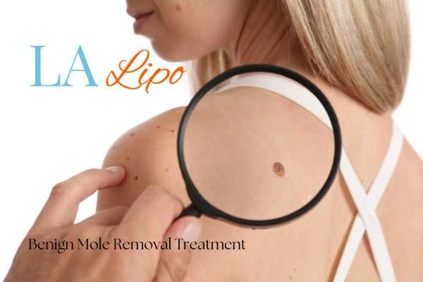 Woman having her inspection of blemish before mole removal Bedford Park