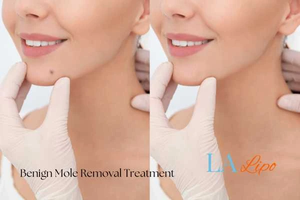woman's before and after mole removal Bedford Park results