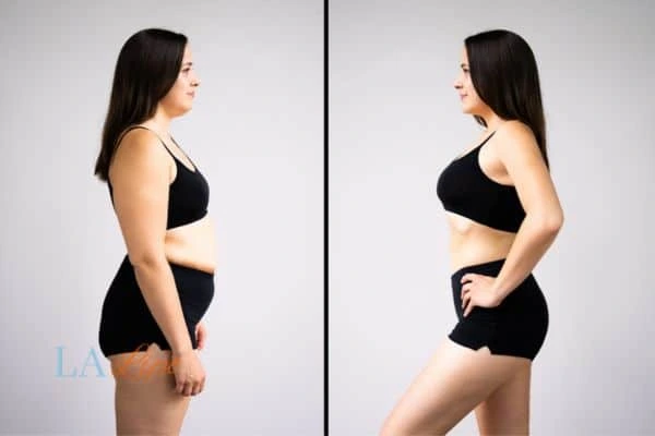 image of woman before and after results of LA-EMS Body Sculpting Bedford Park to help treat Diastasis recti