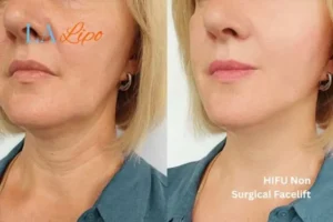 hi-fu for wrinkles Bedford Park before and after results