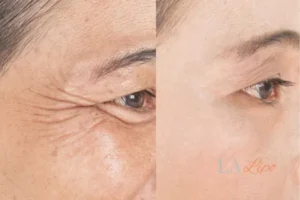 Before and after results of woman - HI-fu wrinkles reduction treatment Bedford Park
