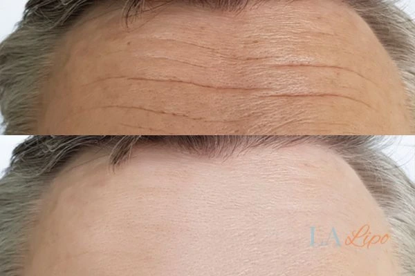 results of HIFU Bedford Park on mans forehead to help reduce lines and wrinkles