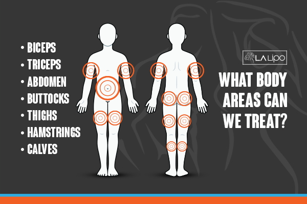 Graphic to show areas you can have LA-EMS Body Sculpting Bedford Park treatment.