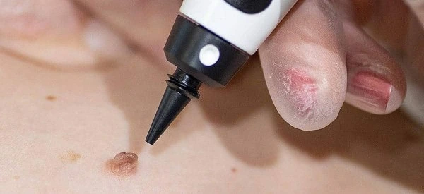 skin tag removal using cryopen Bedford Park