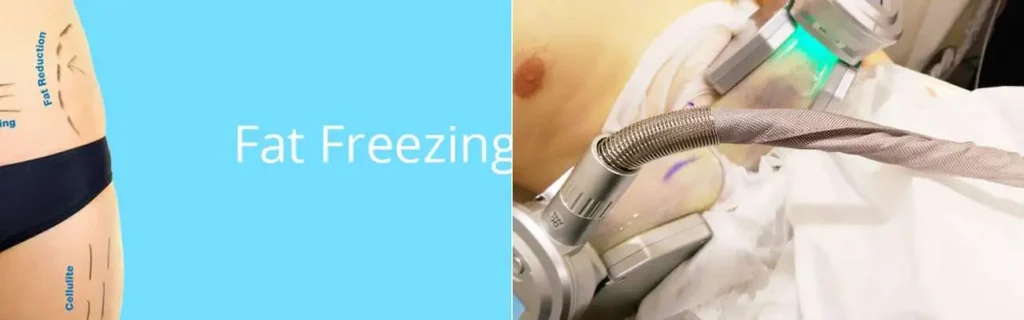 multi areas of a persons body having coolsculpting Bedford Park treatment