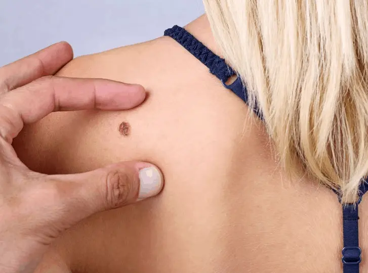 woman having mole removal Bedford Park consultation before treatment.