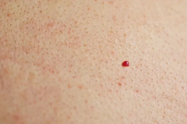 close up of a cherry angioma Bedford Park