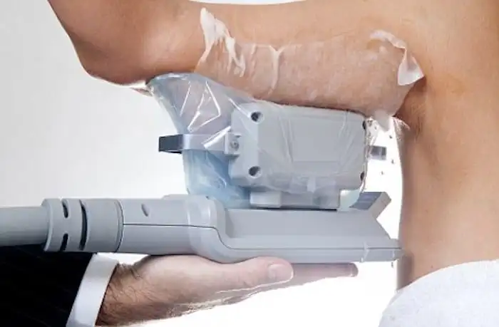 Picture of fat freezing Bedford Park on the upper arms.