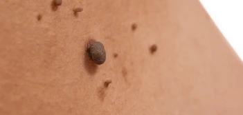 image of a skin tag Bedford Park