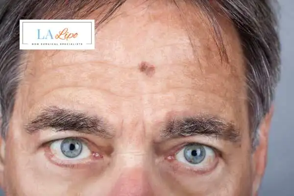 Solar Lentigo Removal Bedford Park image of man with mark on his forehead