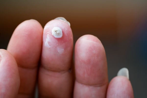 wart on person finger - cryotherapy to treat from LA LIPO Bedford Park