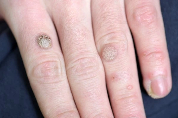 photo of warts on person hand - see wart removal Bedford Park from LA LIPO
