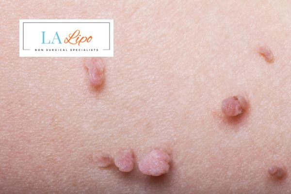 Does cryopen skin tag removal Bedford Park hurt? Find out now call our team today!