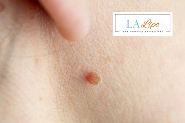 Book skin tag removal Bedford Park today speak to our team now!