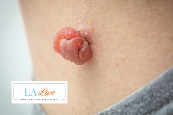 Interested in skin tag removal Bedford Park? Concerned about the pain? Find out more today!