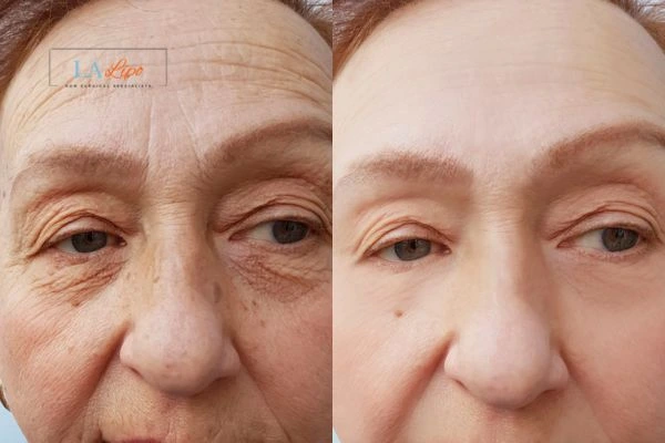 The powerful benefits of Morpheus8 Treatment Bedford Park - Call Our team today!