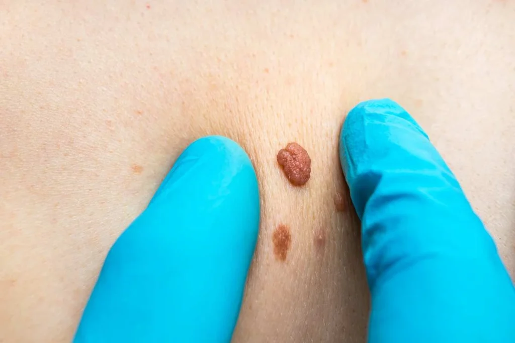 LA LIPO Cryopen Lesion Removal Prices Bedford Park