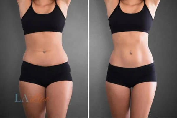 before and after results of non-surgical treatment to help a woman's body image and mental health Bedford Park