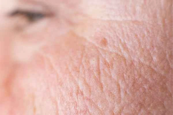 close up picture of a woman's face showing an age spot Bedford Park