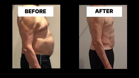 What Symptoms Can Diastasis Recti Cause in Men? Weak Core, Back Pain and Poor Posture Bedford Park